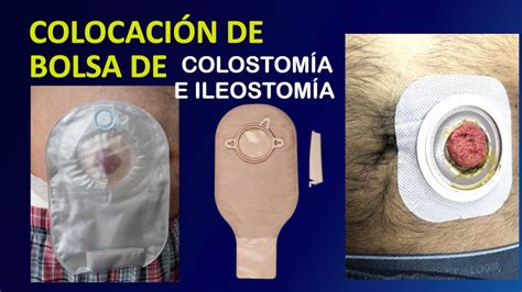 colostomia infectada